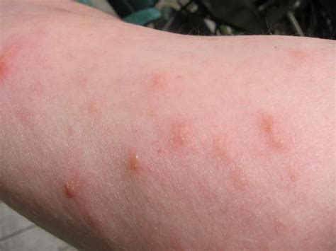 Poison Ivy Rash Photos Of Poison Ivy Rashes Poison Ivy Cures Help