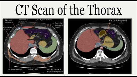 Ct San Of The Thorax Youtube