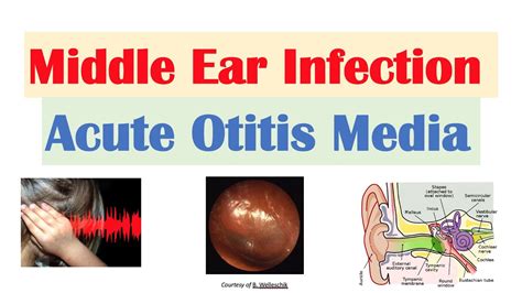 Middle Ear Infection Acute Otitis Media Causes Symptoms Diagnosis My