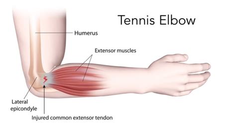 Learn when to call the doctor and what to expect from your appointment. Tennis Elbow - what causes it, symptoms and treatment ...
