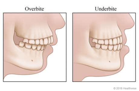 Overbite Vs Underbite What It Is And How To Fix With Mewing