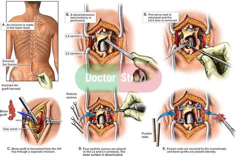 Back Surgery L4 L5 Laminectomy L4 5 Discectomy Diskectomy And Spinal Fusion With Pedicle