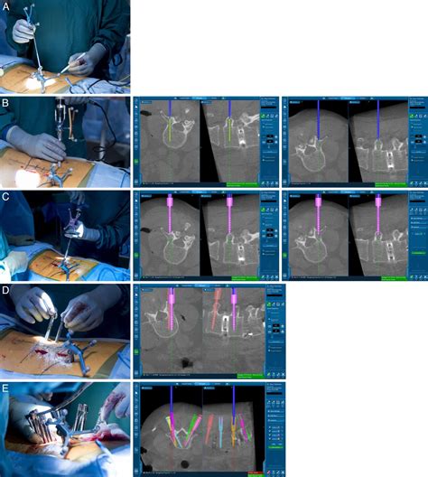 Minimally Invasive Stereotactic Wireless Percutaneous Pedicle Screw Placement In The Lumbar