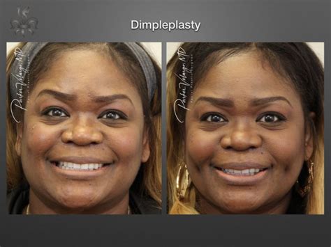 Dimpleplasty Archives New Orleans Premier Center For Aesthetics And Plastic Surgery