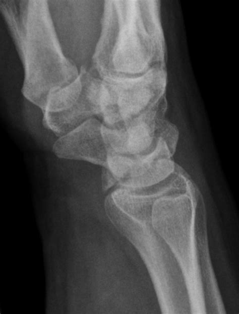 Chauffeur fracture | Image | Radiopaedia.org