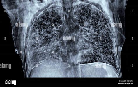 Miliary Tuberculosis 3d Ct Scan Stock Photo Alamy