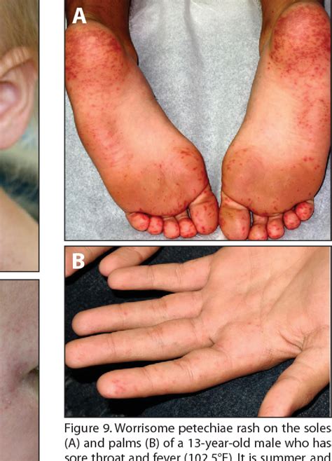 Figure 10 From Petechiae And Purpura The Ominous And The Not So