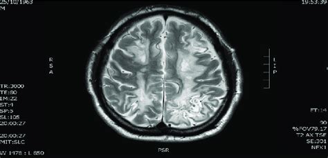 Showing Diffuse White Matter Lesions On Mri Of Brain T2 Axial