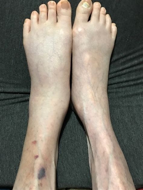 Dvt, deep vein thrombosis, thrombosis. 下肢深部静脈血栓症(DVT)-サルコイドーシス下関 本州西先端より
