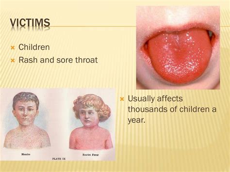 Ppt Scarlet Fever Streptococcus Powerpoint Presentation Free