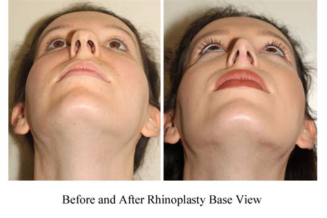 Tip Refinement And Deprojection Dr Denton Vancouver Surgeon