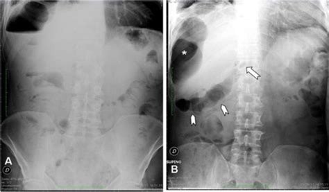 Perforated Duodenal Ulcer Presenting With A Subphrenic Abscess Revealed