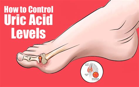 How We Can Know High Uric Acid In Body Nano Photon Homeopathic