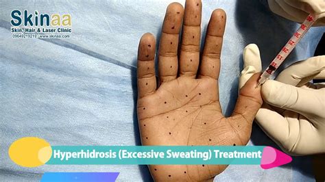 Hyperhidrosis Excessive Sweating Treatment In India Botox Injection