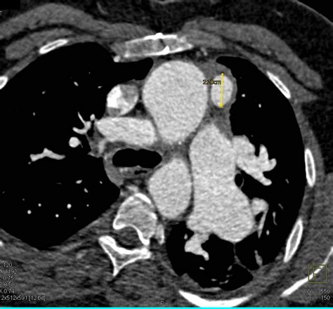 Pseudoaneurysm Off Aortic Arch Chest Case Studies Ctisus Ct Scanning