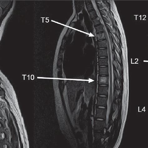 Mri Scan Of Whole Spine Revealed Multiple Lytic Lesions Are Seen At