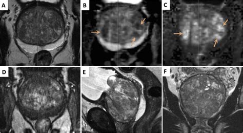Multiparametric Magnetic Resonance Imaging For The Detection Of Clinically Significant Prostate