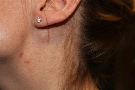 Swollen Lymph Nodes Ear
