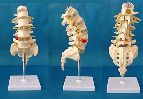 Buy Medical Human Spine Spine Pathology Demonstration Model Anatomical