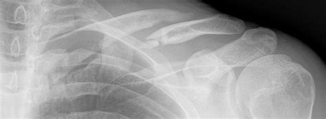 Clavicle Fracture Mechanism Of Injury And Treatment Options For This
