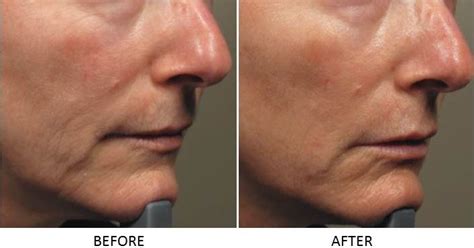 Resurfx Is A Fractional Non Ablative Laser Technology Commonly Used