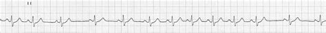 Sinus Arrhythmia Litfl Medical Blog Ecg Library Basics