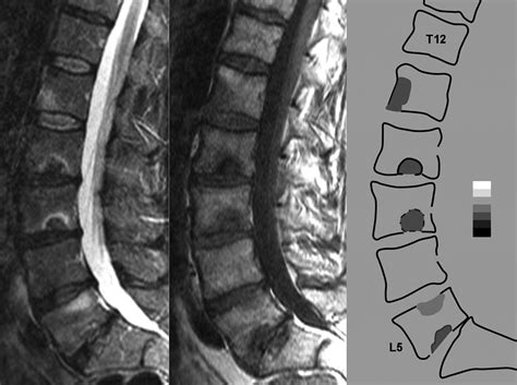 Structural Lesions Detected By Magnetic Resonance Imaging In The Spine