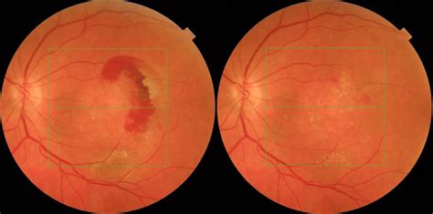 Age Related Macular Degeneration Amd The Retina Clinic London