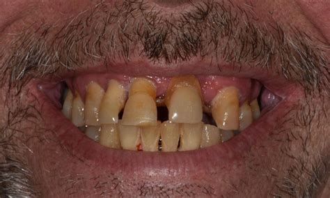 Dental Extractions Barrie On Full Mouth Treatment Smile Gallery