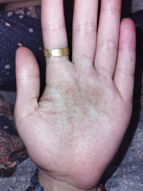My Girlfriend Recently Returned From Egypt With This Rash In Both Palms