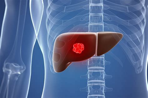 Liver Resection May Close Racial Gap In Overall Survival Among Patients