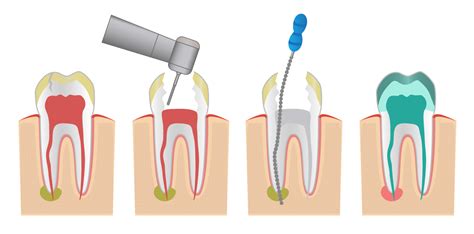 Sin embargo les damos el beneficio a nuestros pacientes que ya tienen una historia clínica con nosotros. ¿Qué esperar de una endodoncia? — Odontologic