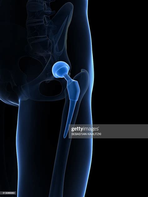Human Hip Replacement Artwork High Res Vector Graphic Getty Images