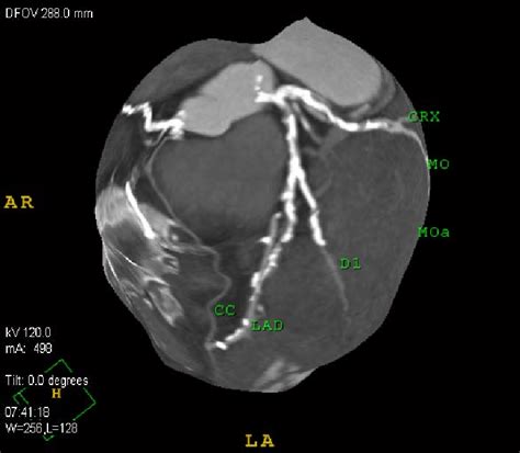 Check spelling or type a new query. 3 D map of coronary arteries: LAD: left descending ...