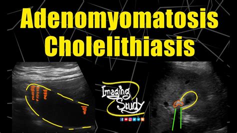 Adenomyomatosis Cholelithiasis Ultrasound Case Youtube