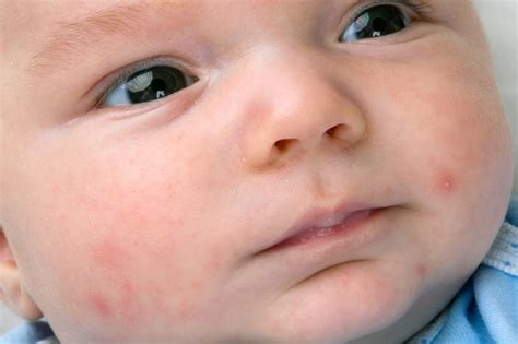 Viral Rashes On Babies