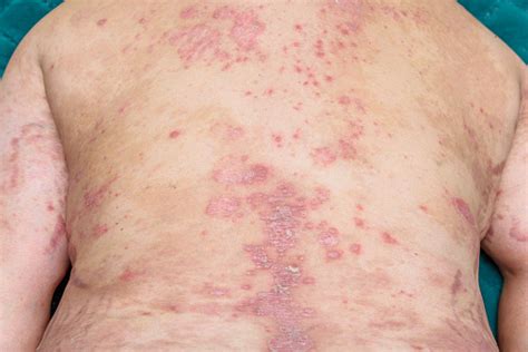 Psoriasis Skin Psoriasis Is An Autoimmune Disease That Affects The Skin