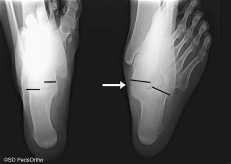 Radiographic Evaluation Harris Heel View Left Is Normal With Parallel