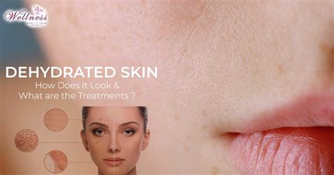 Dehydrated Skin How Does It Look And What Are The Treatments