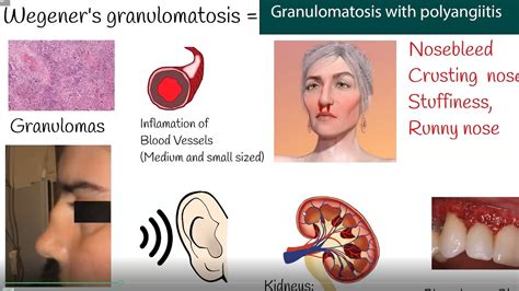 Wegeners Granulomatosis Granulomatosis With Polyangiitis Symptoms