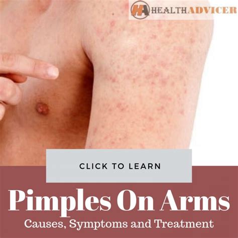 Pimples On Arms Causes Picture Symptoms And Treatment