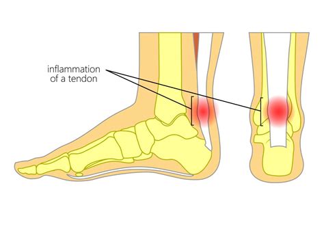 Achilles Tendonitis Symptoms And Treatment Caruso Foot And Ankle