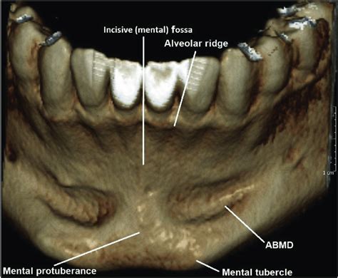 A Volumetrically Rendered Cbct Image Of The Anterior Mandible Showing