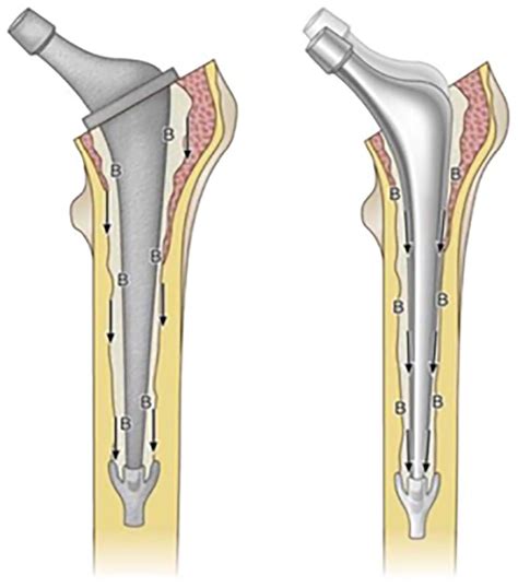 Survival Rates Of Anatomically Shaped And Tapered Slip Cemented Femoral