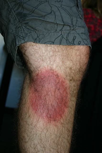 La maladie de lyme est une maladie vectorielle et une zoonose (maladie infectieuse touchant l'être humain et de nombreux animaux). Traitement maladie de lyme - Carabiens le Forum
