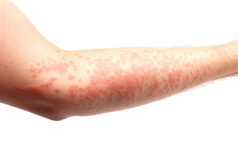 Hives Urticaria Causes Treatment And Symptoms