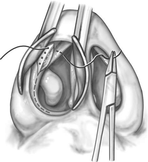 Nasal Valve Stabilization Operative Techniques In Otolaryngology Head