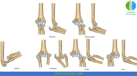 Elbow Dislocation Easy Explained Orthofixar 2023