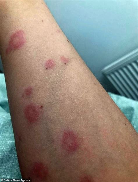 Hives can be triggered by many situations and substances,. Woman, 21, is branded contagious for hives all over her ...