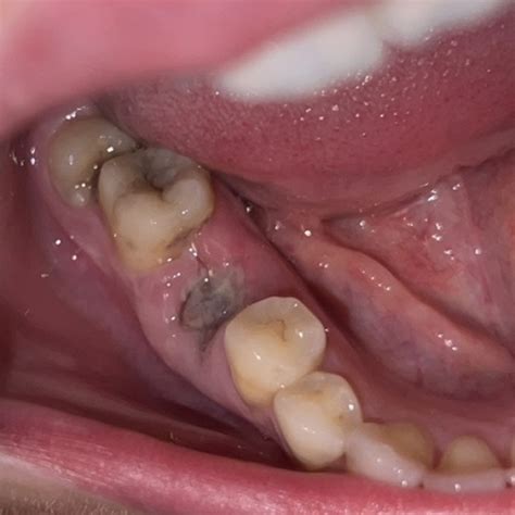 Any Dentists Is This Dry Socketan Infection Mumsnet